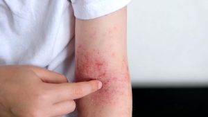 Dermatite atopica: A Roma una giornata di visite di screening gratuite su prenotazione