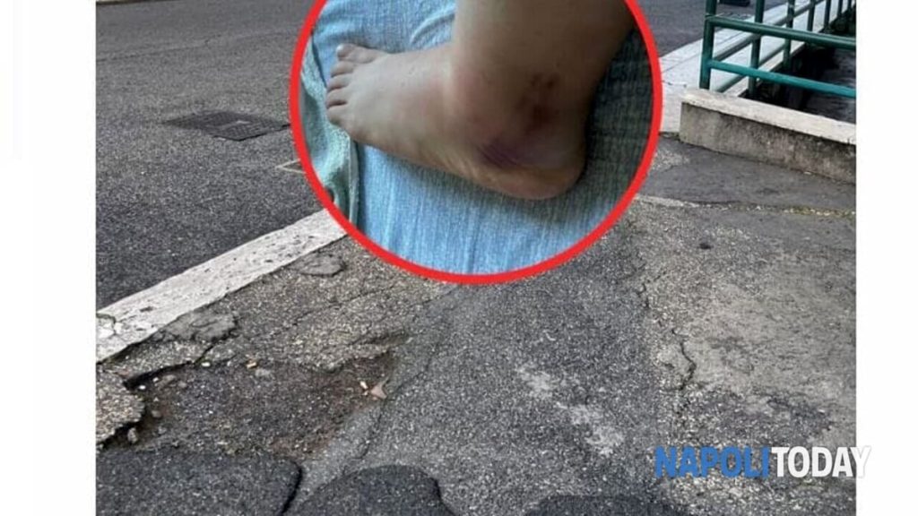 Cade in una buca e finisce in ospedale. Lo sfogo della laureanda: "Costretta a saltare il tirocinio"