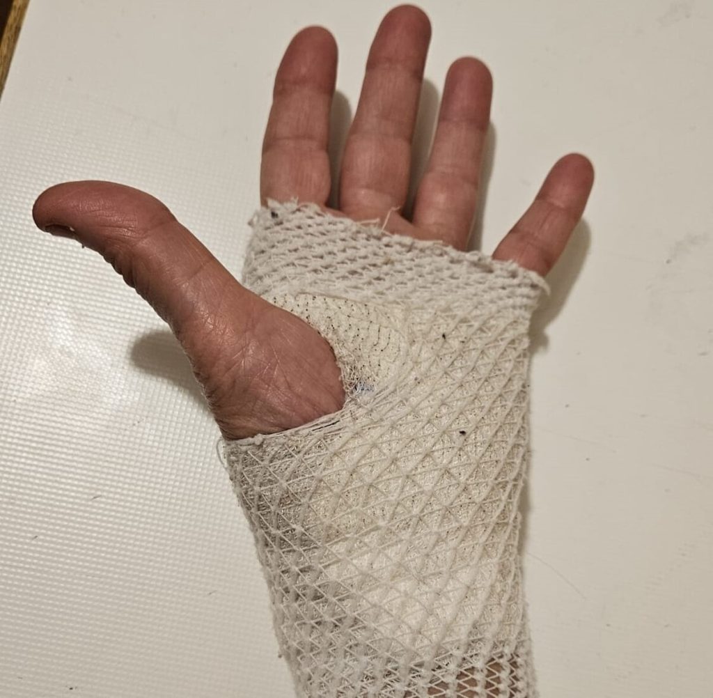 Anziana azzannata alla mano da un cane mentre passeggia in strada